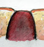 retracted_stoma retracted_stoma