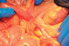 Adhesion-Fihure-1 Adhesion-Fihure-1