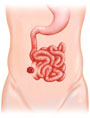 ileostomy