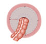 Fig–4–Mesh-repair-Keyhole Fig--4--Mesh-repair-Keyhole