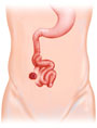 ileostomy_ShortBowel ileostomy_ShortBowel