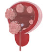 BladderCancer BladderCancer